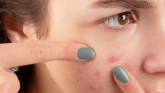 8 Mitos sobre el acné que deberías saber