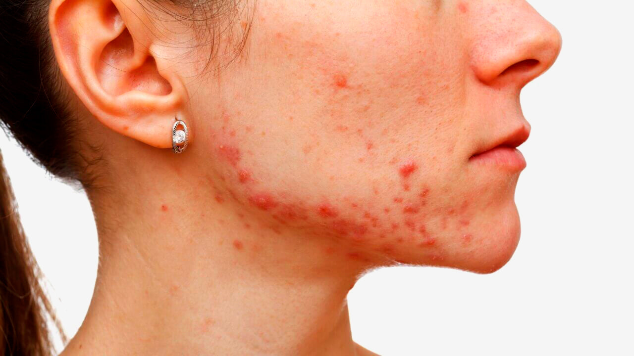 5 Herramientas endocrinológicas para el tratamiento del Acné hormonal