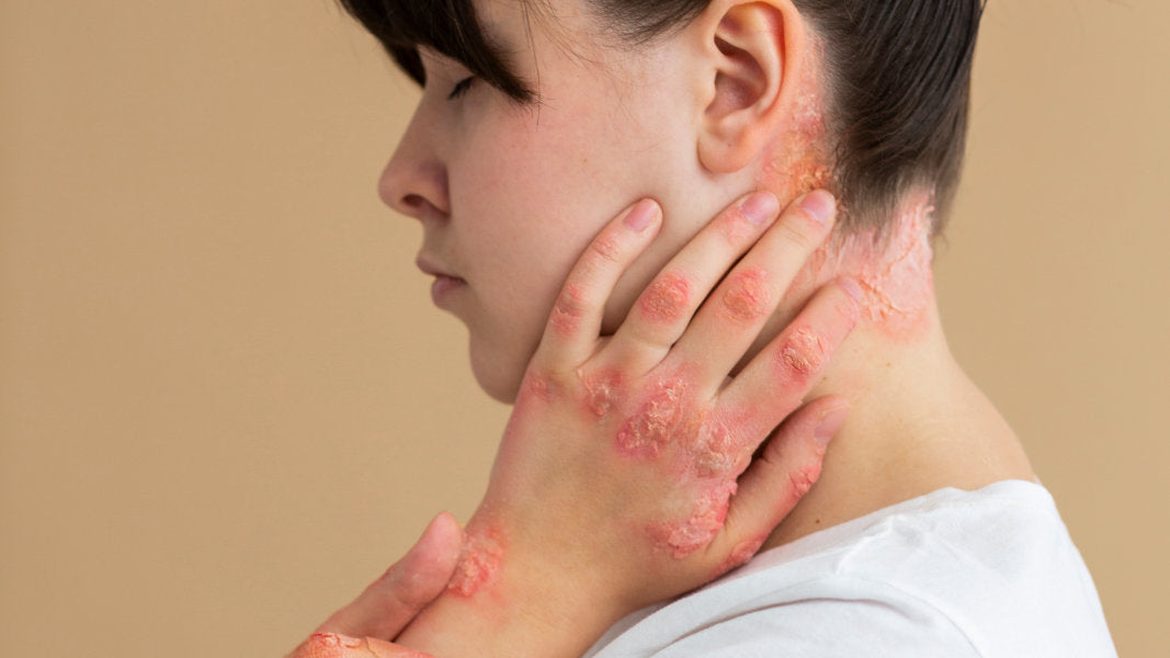 Psoriasis inversa: Causas, síntomas y cuándo consultar al médico