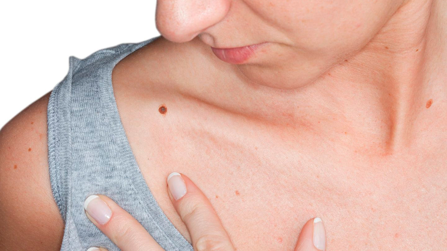 Mujer mirando un lunar sospechoso de melanoma.