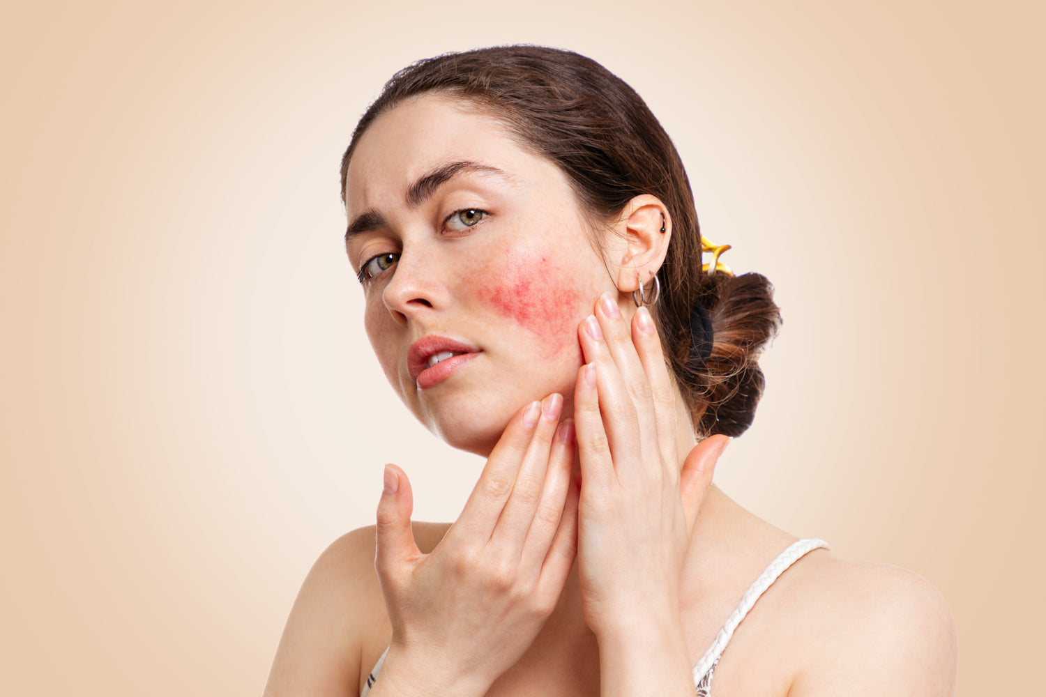 Mujer con rosácea facial