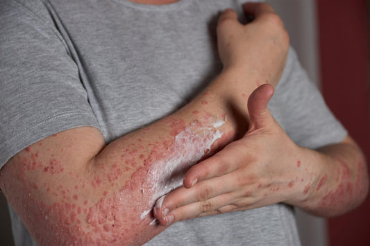 Pasos clave para desinfectar piel y nariz, y eliminar la bacteria de tu cuerpo